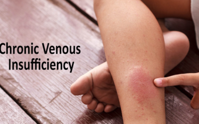 The stages of chronic venous insufficiency